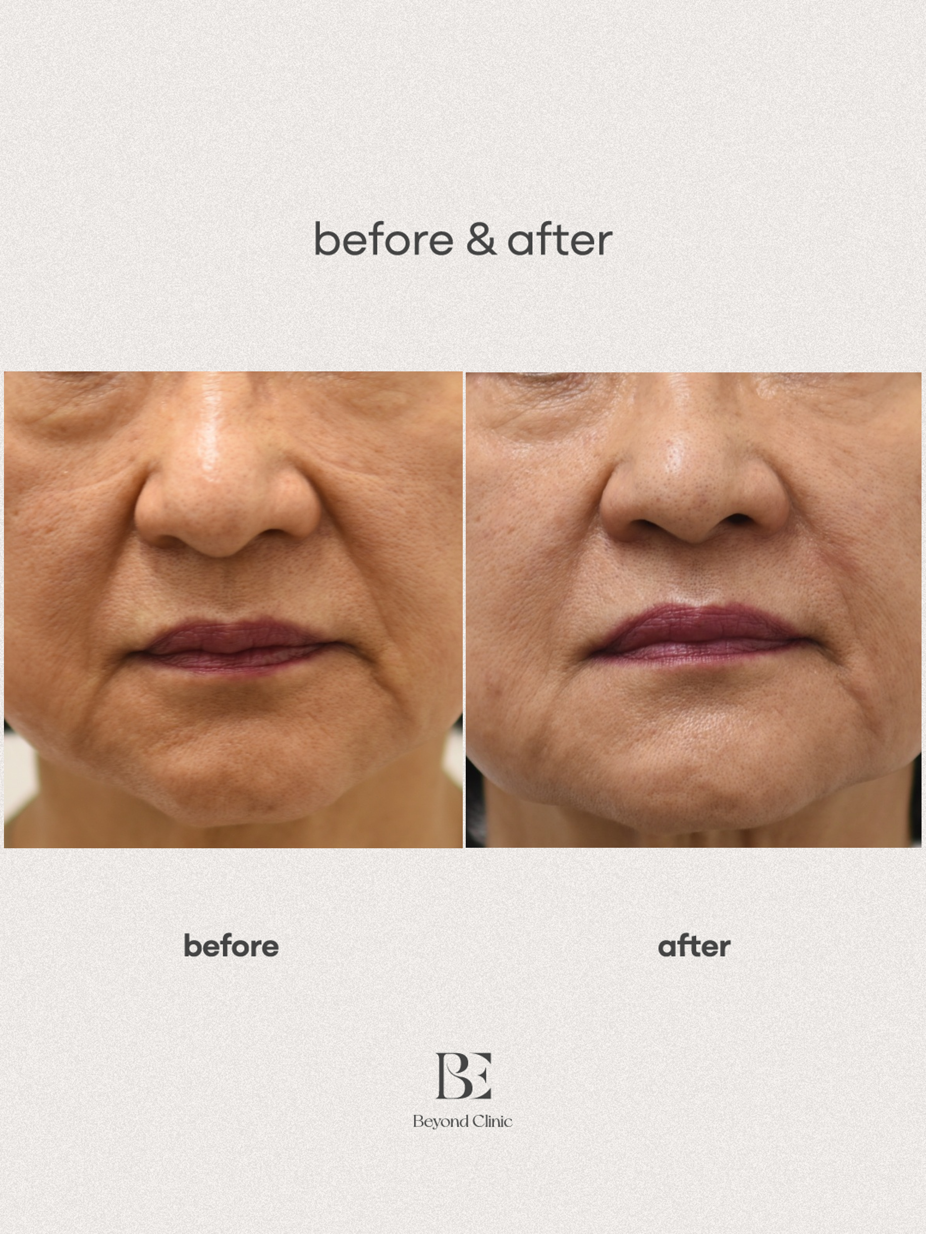 팔자주름 레디어스