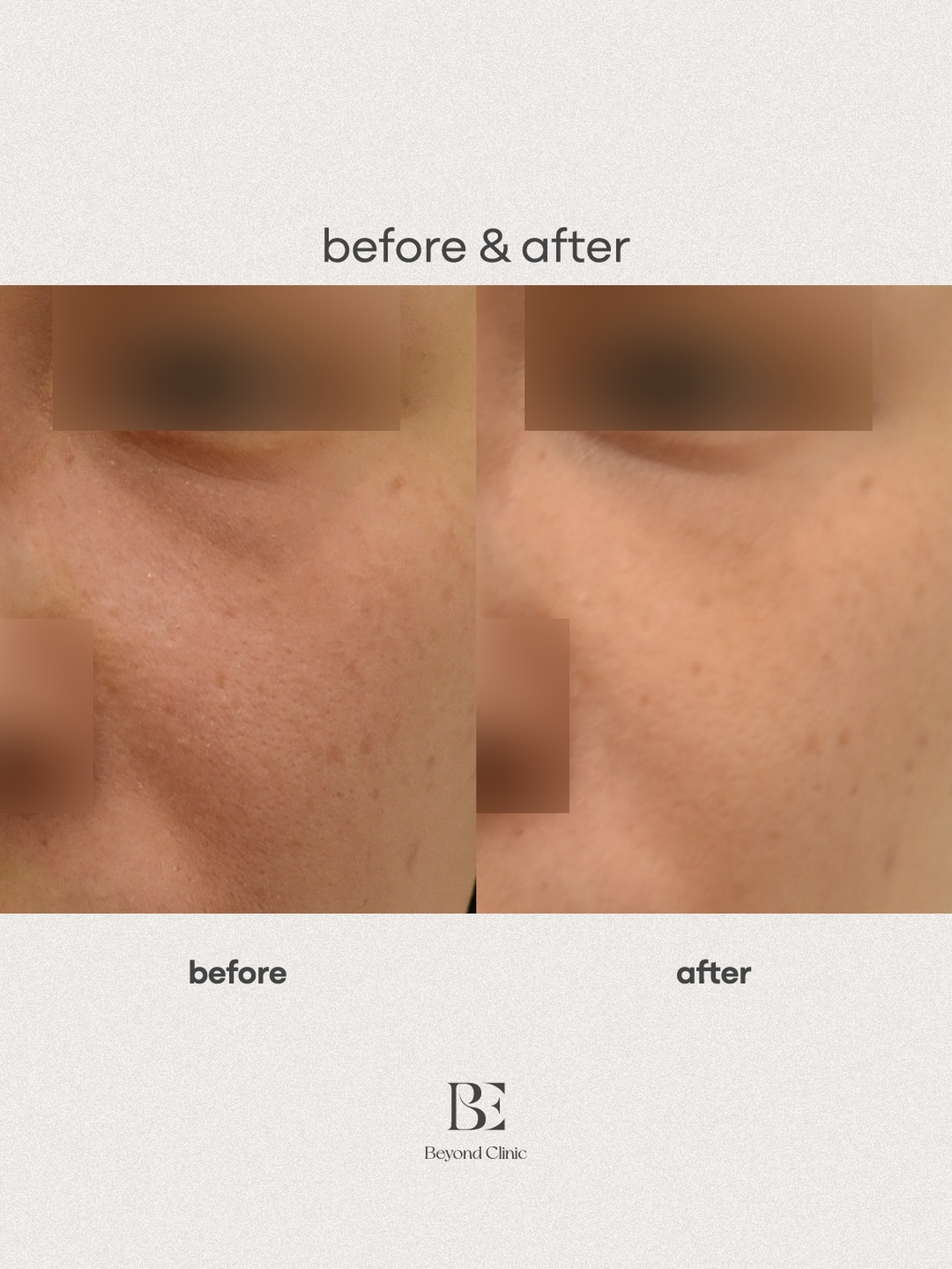 눈밑 울트라콜 (다크서클 교정)