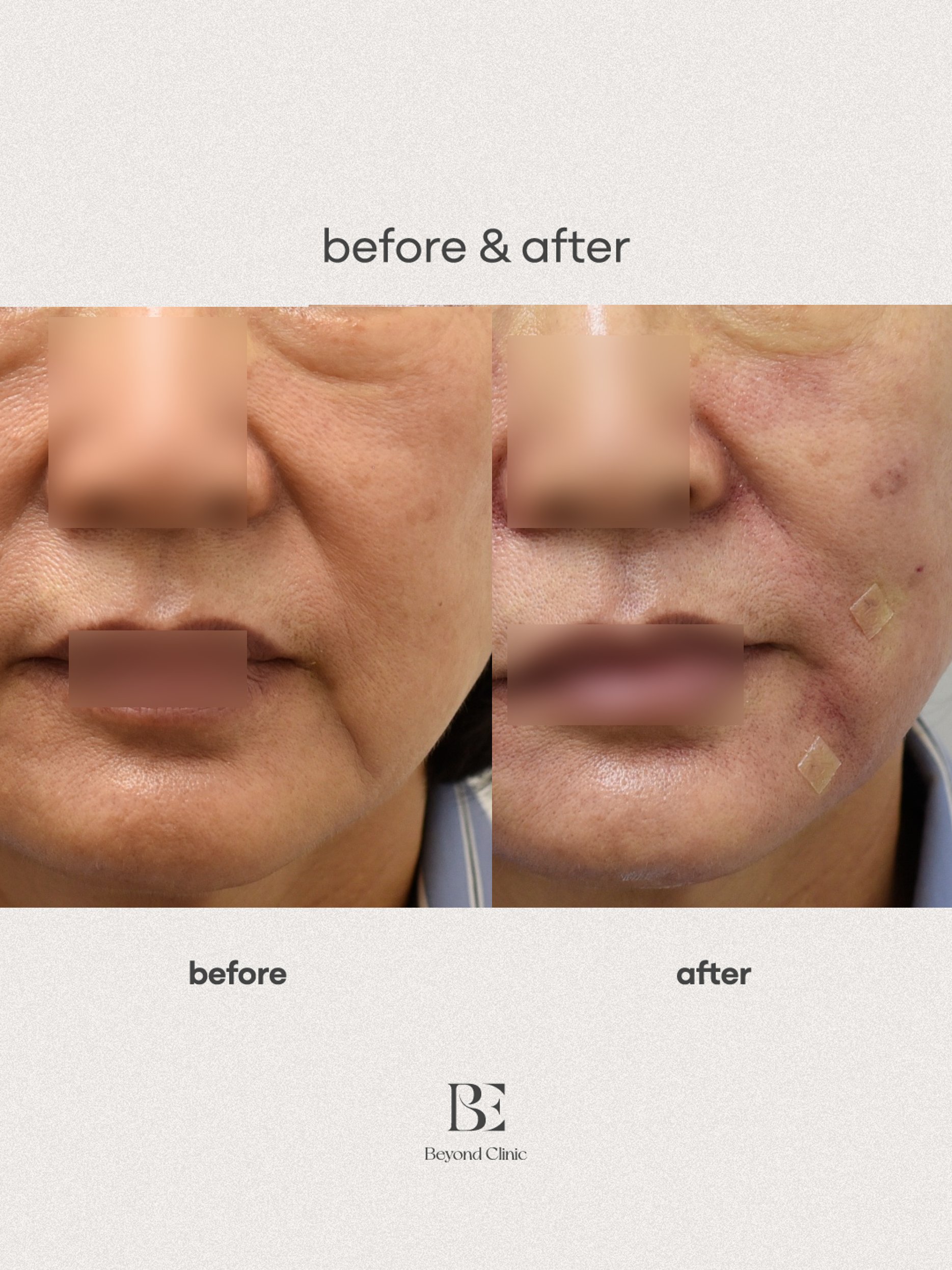 팔자 마리오네트 잼버실