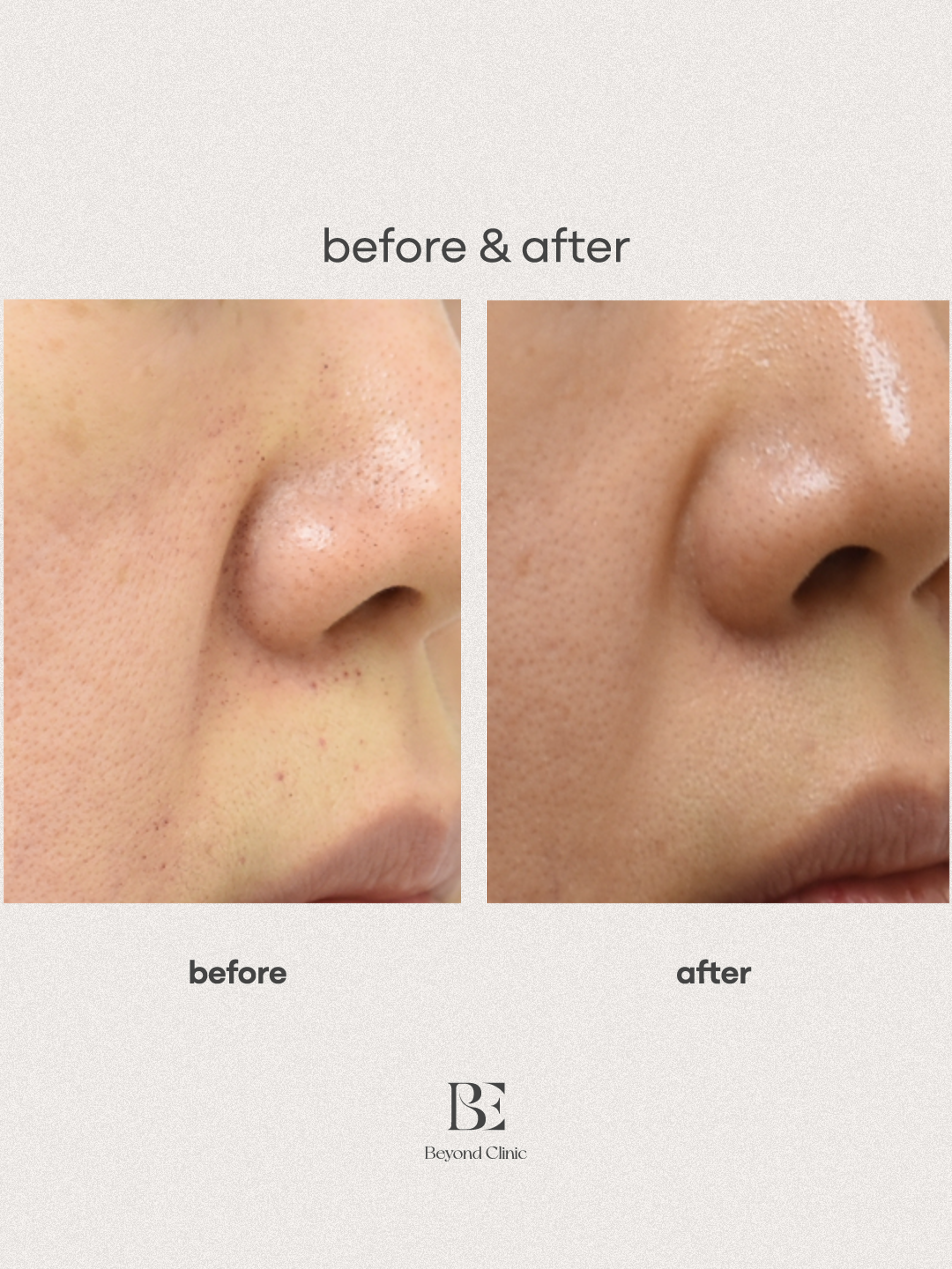 smile lines filler+JAMBER F