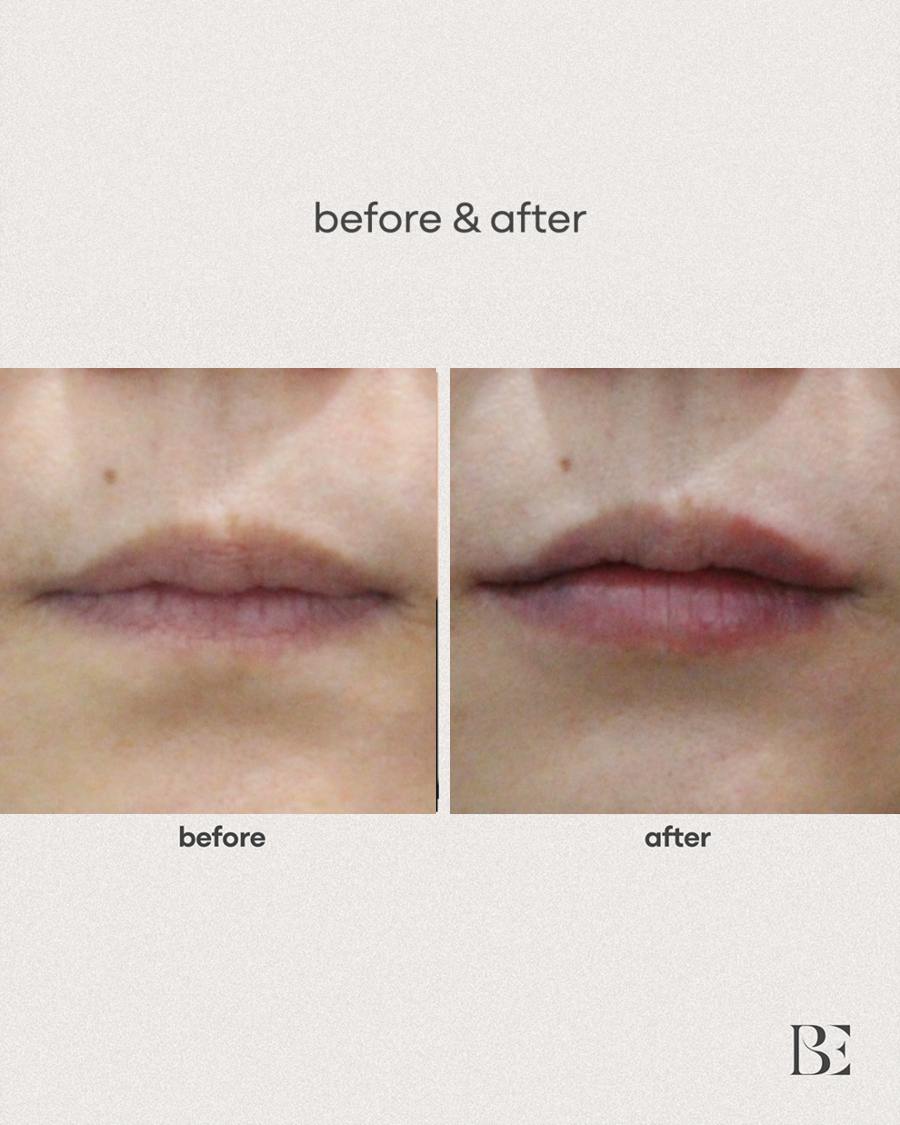 Lip filler
