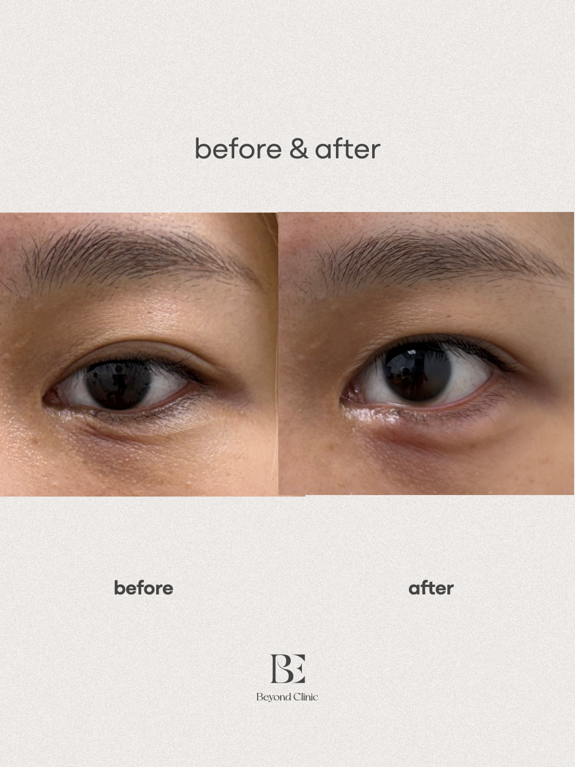 Pretarsal Roll (Ae-gyo sal) Filler