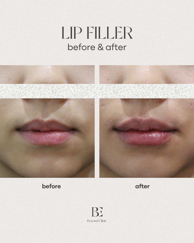 Lip filler